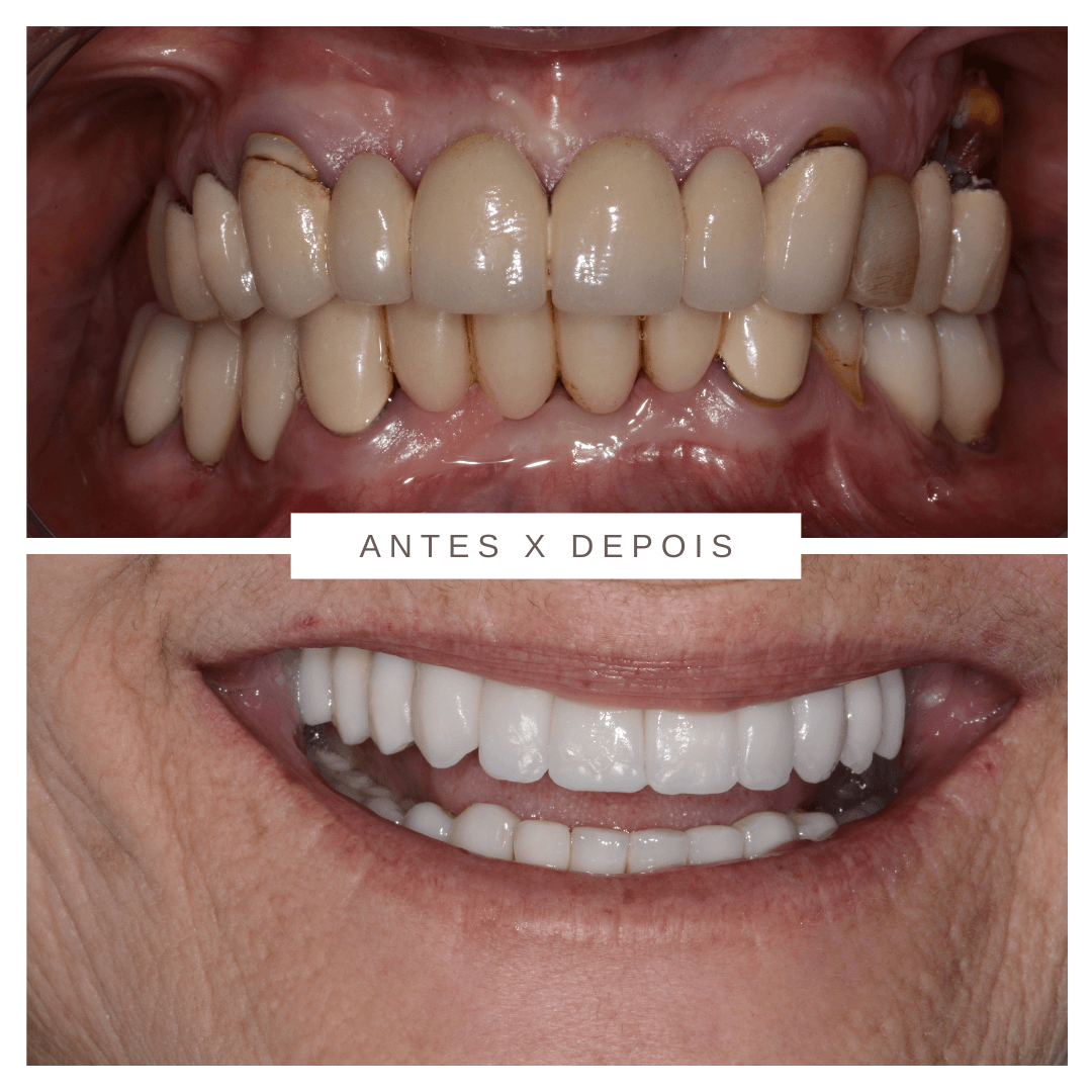 Antes e depois de paciente tratado com Método TCO no HEO
