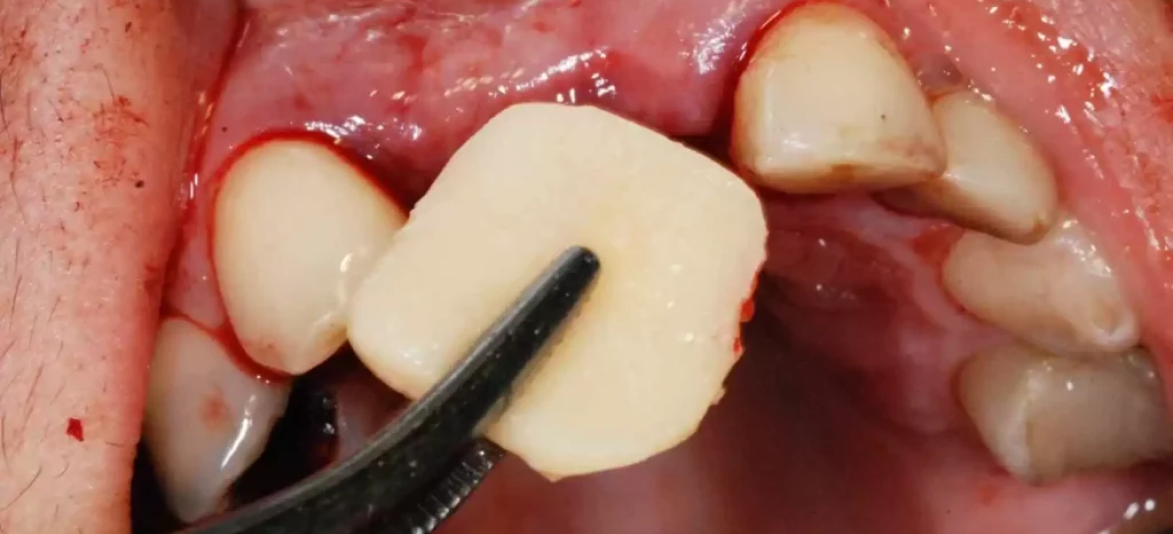 Problemas e limitações do enxerto autógeno tradicional em odontologia