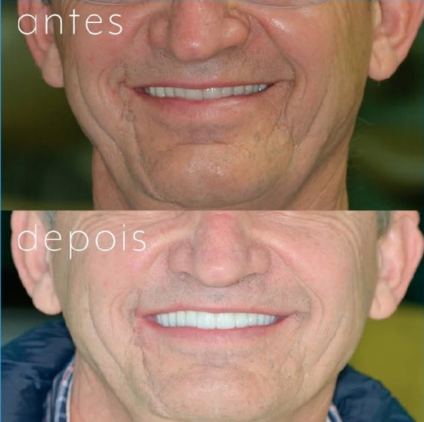 Antes e depois de casos de sucesso de implante com enxerto no HEO