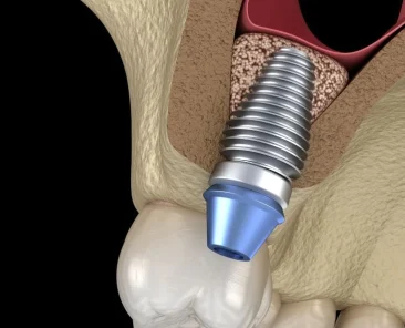 Levantamento de seio maxilar: procedimento que aumenta o osso da maxila para implante dentário