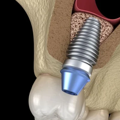 Levantamento de seio maxilar: procedimento que aumenta o osso da maxila para implante dentário